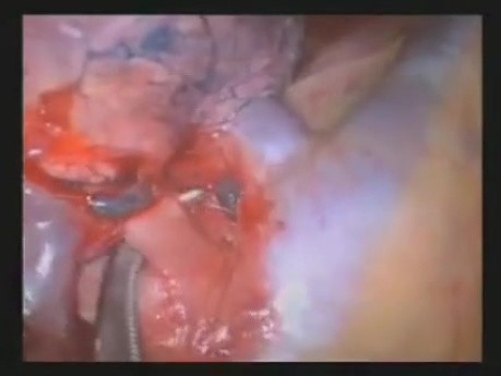 Uniportal VATS Right Upper Lobectomy And Anatomic Segmentectomy