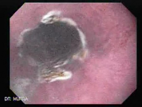 Barrett's Esophagus of long segment -final state after APC (9 of 11)
