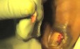 Stage-3 Ingrown Toenail: SilverNitrate.mov