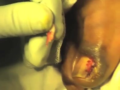 Stage-3 Ingrown Toenail: SilverNitrate.mov