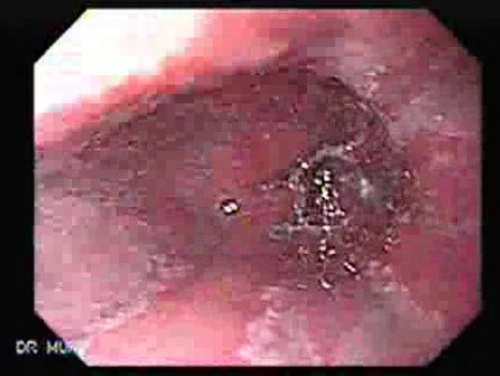 Barrett's Esophagus of long segment (2 of 11)