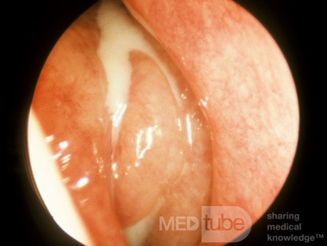 Orbital Cellulitis Secondary To Acute Pansinusitis 3