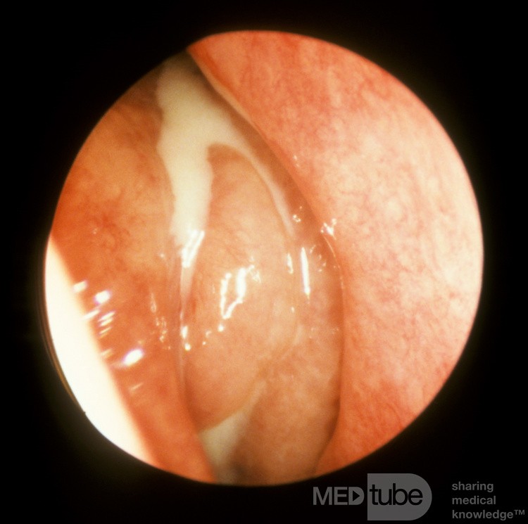 Orbital Cellulitis Secondary To Acute Pansinusitis 3
