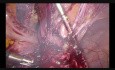 Laparoscopic hysterectomy. Status after 3 cesarean sections. 