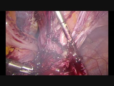 Laparoscopic hysterectomy. Status after 3 cesarean sections. 
