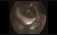 Functional Aphonia
