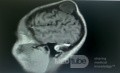 Epicranial Tumor Injury
