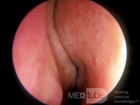 Rhinitis Medicamentosa