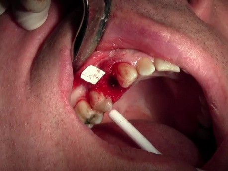 Extraction #5 with Socket Bone Grafting - d-PTFE