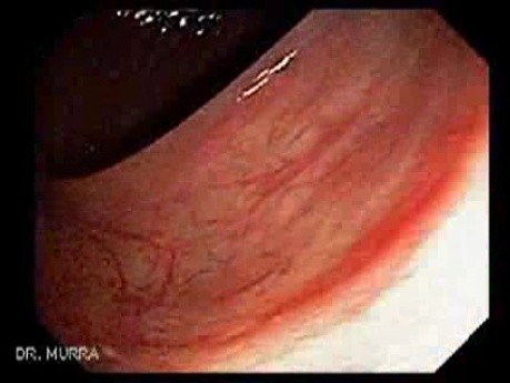 Colon Cancer - Endoscopy (2 of 3)