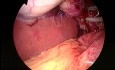 SILS cholecystectomy