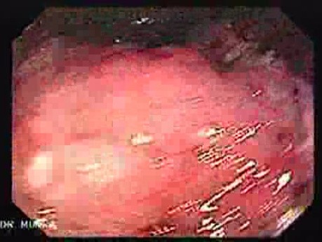 Rectal Adenocarcinoma (2 of 12)
