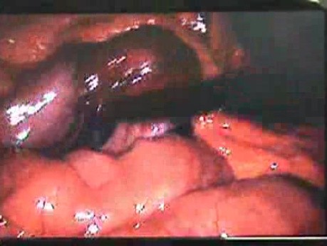 Jejunal Gastrointestinal Stromal tumor (GIST) (18 of 86)