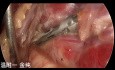 Dual-port Trans-subclavian Thyroid Endoscopic Surgery (part 5)