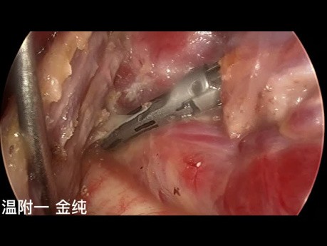 Dual-port Trans-subclavian Thyroid Endoscopic Surgery (part 5)