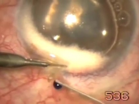 Pupillary glaucoma management