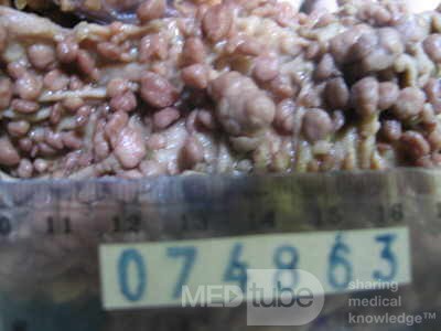 Synchronous Cancers, Familial Adenomatous Polyposis (30 of 36)
