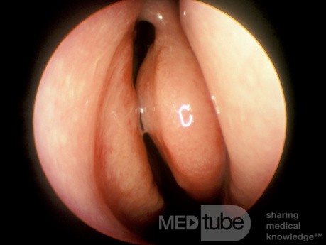 Acute Maxillary Sinusitis [after treatment]