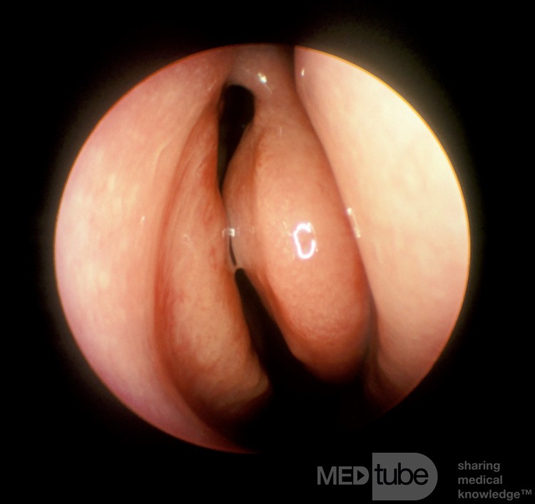 Acute Maxillary Sinusitis [after treatment]
