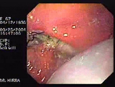 Partial Dehiscence of Suturing with Gastro-cutaneous Fistula (2 of 4)