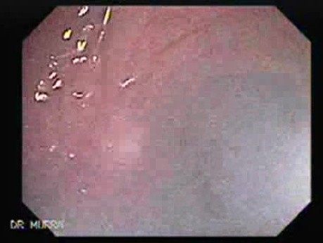 Rectal Stalked Polyp (4 of 7)