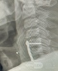 Cloward's Anterior Approach for AO Spine Type C Cervical Fracture with Brown Sequard Syndrome