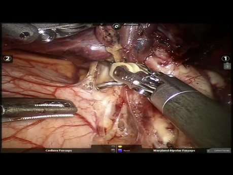Lung Cancer - VAMLA and Robotic Left Upper Lobectomy