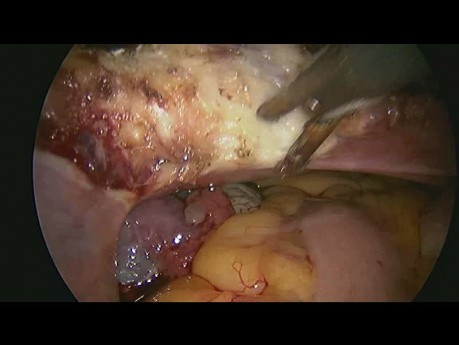 TLH + BS with 5mm Trocar in Case of Previous LSCS