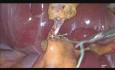 Minilaparoscopic Clipless Cholecystectomy