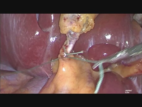Minilaparoscopic Clipless Cholecystectomy
