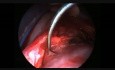 Endoscopic Parapharyngeal Tumour Excision