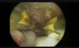 Bipolar Hysteroscopic Myomectomy