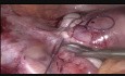 Laparoscopic Myomectomy of Case of Broad Ligament Wall Fibroid