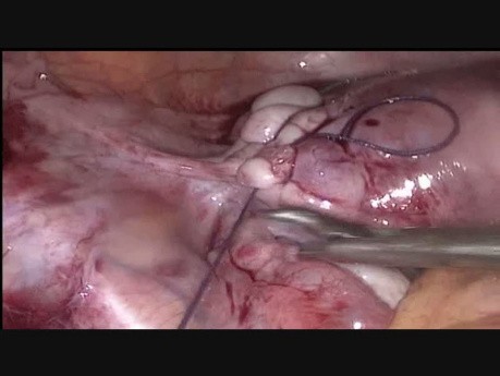 Laparoscopic Myomectomy of Case of Broad Ligament Wall Fibroid