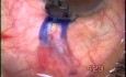 Trabeculectomy complications treatment - treatment of tenon cyst with use of Fugo Blade
