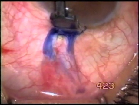 Trabeculectomy complications treatment - treatment of tenon cyst with use of Fugo Blade