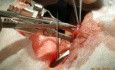 Vasectomy - Reversal - Infertility Treatment