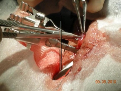 Vasectomy - Reversal - Infertility Treatment