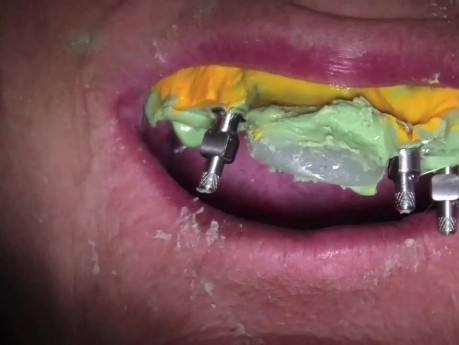 Open Tray Impression - Stabilize Multiple Implants During Final Impression