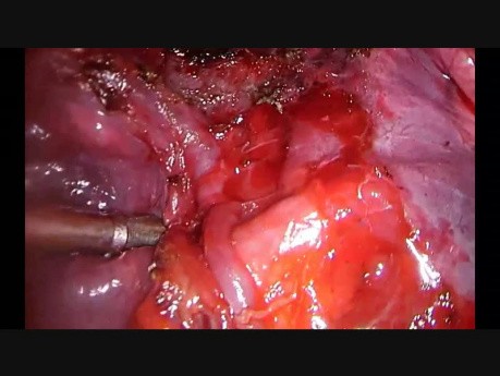 Fissureless Uniportal VATS Left Lower Lobectomy with Aberrant Lingular Vein