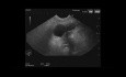 Endoscopic Ultrasound for Pancreatic IPMN