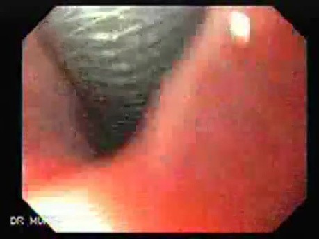 Adenocarcinoma of the Cardias - Controlled Release Esophageal Stent System