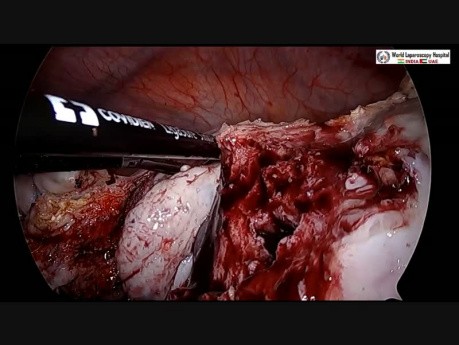 First in the World 3.5 Kg Fibroid, Ovarian Cyst, Gallbladder & Appendix Removed by Laparoscopy