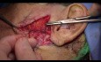 Preauricolar transparotid approaches in bilateral extracondilar mandibular fractures. 