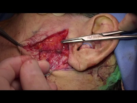 Preauricolar transparotid approaches in bilateral extracondilar mandibular fractures. 