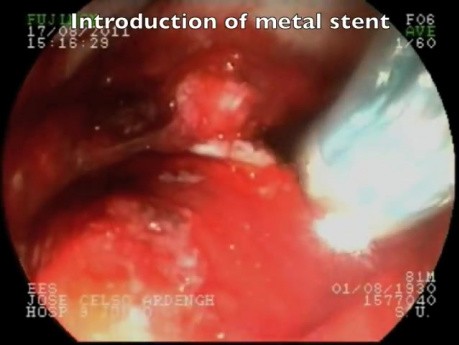 Duodenal papila tumor- endoscopic treatment