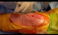 TKA: 3 Layer Closure Using Quill Barbed Suture by Dr  Danoff J., USA