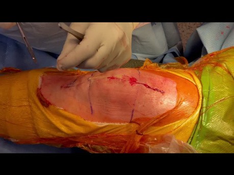 TKA: 3 Layer Closure Using Quill Barbed Suture by Dr  Danoff J., USA