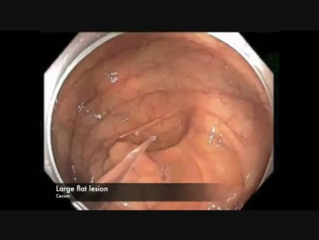 Cecum-EMR Bleed-Position Change-A