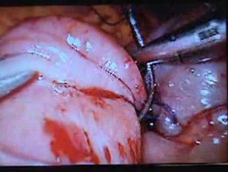 Jejunal Gastrointestinal Stromal tumor (GIST) (77 of 86)